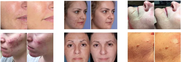 ضوء الوجه LED الأشعة تحت الحمراء LED العلاج PDT LED Professionele Machine Bio Photomodulation ضوء العلاج الضوئي LED 4
